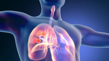 Pfizer Moves Deeper Into ADCs With Pivotal Lung Cancer Trials